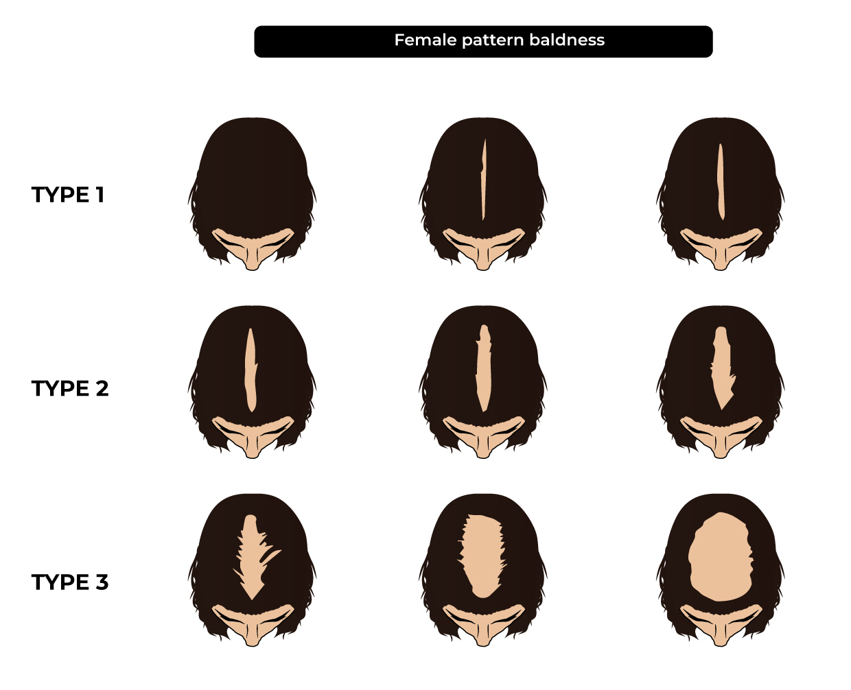Female Baldness Pattern
