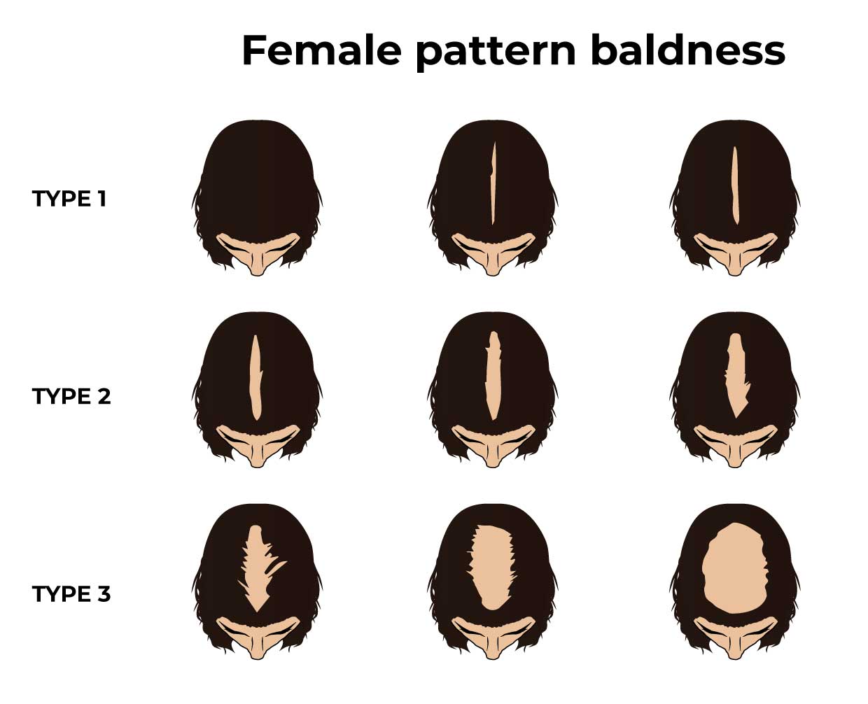 Patterns of female hair loss