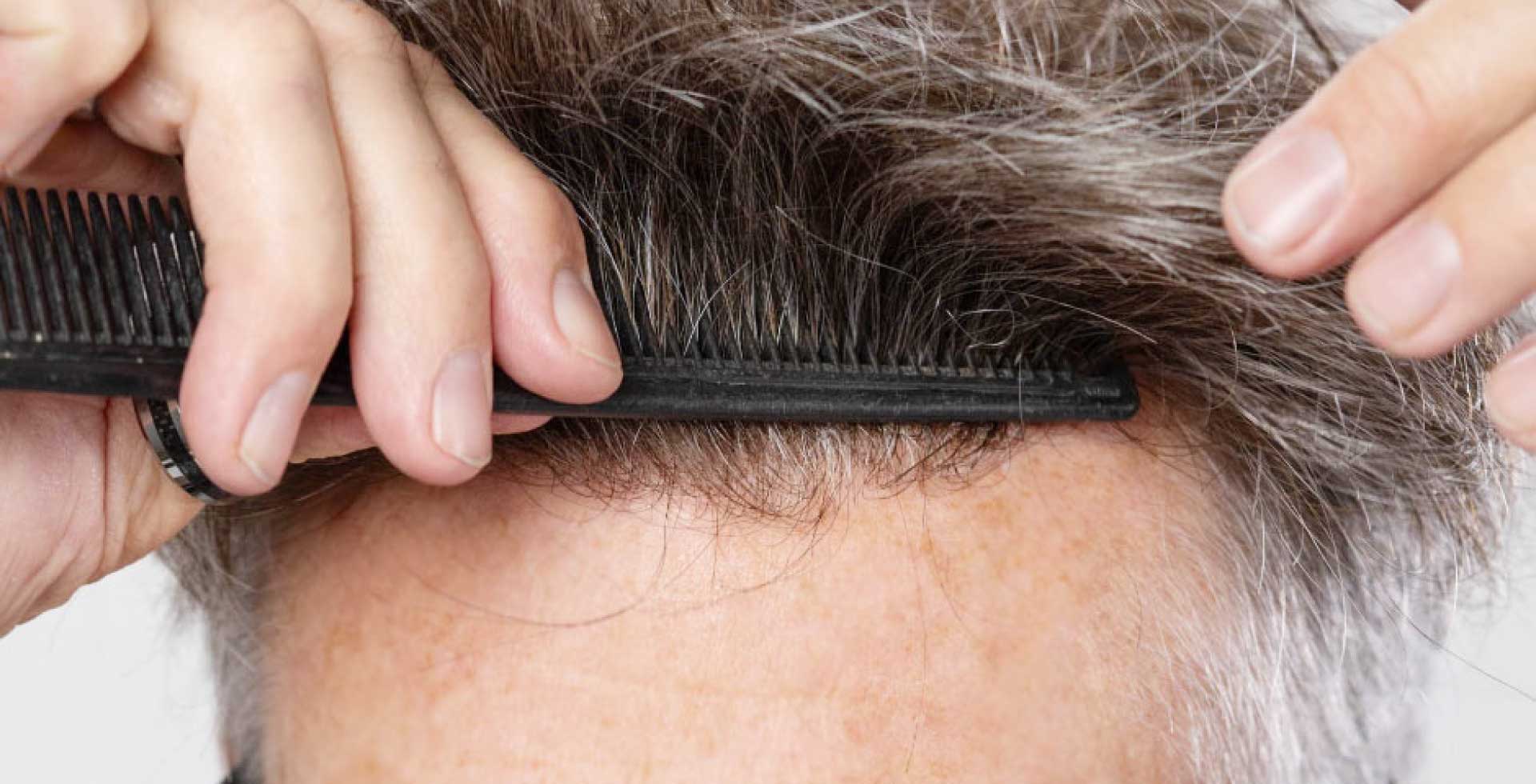 image of choosing the right hairline