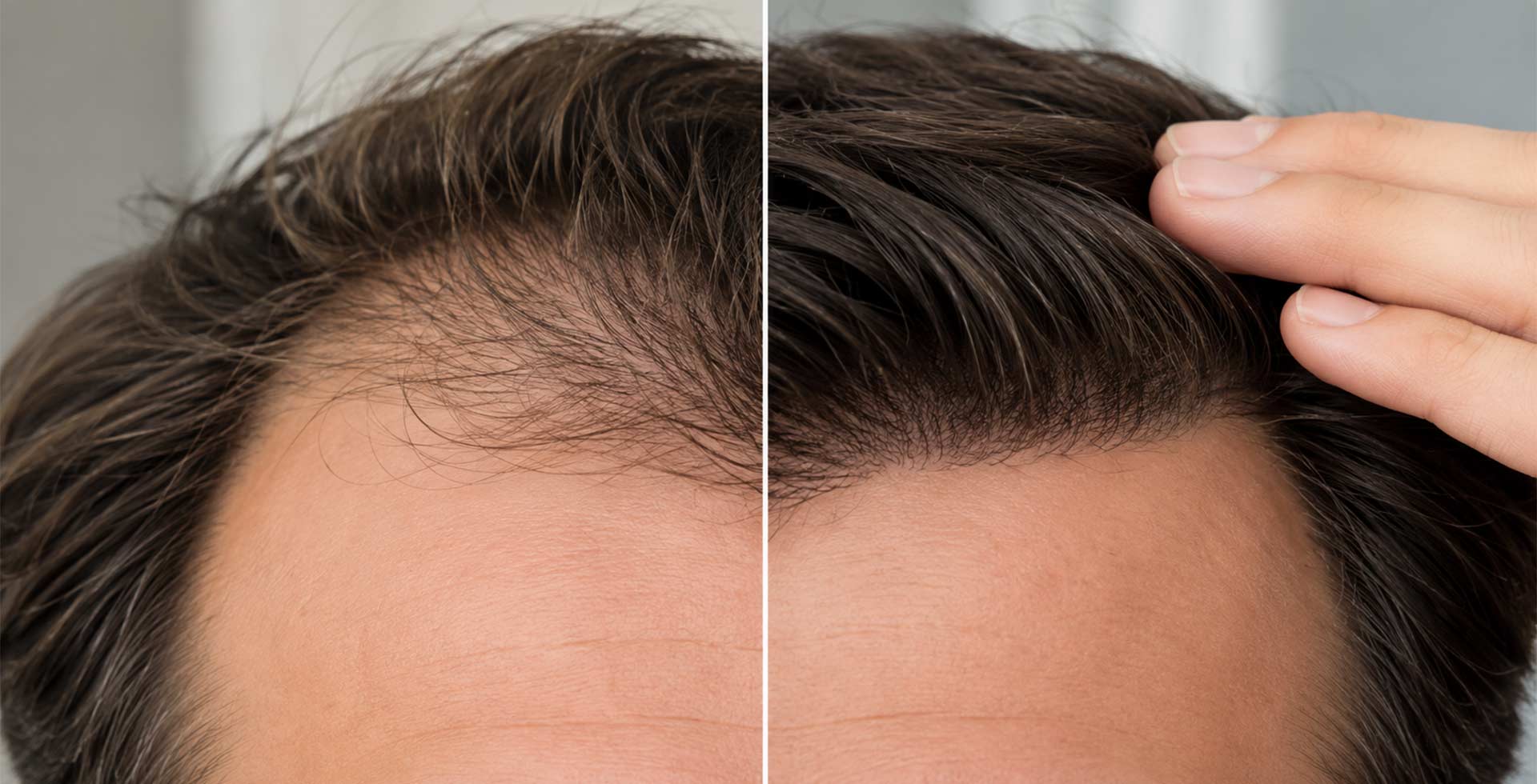 hair patch at Superhairpieces