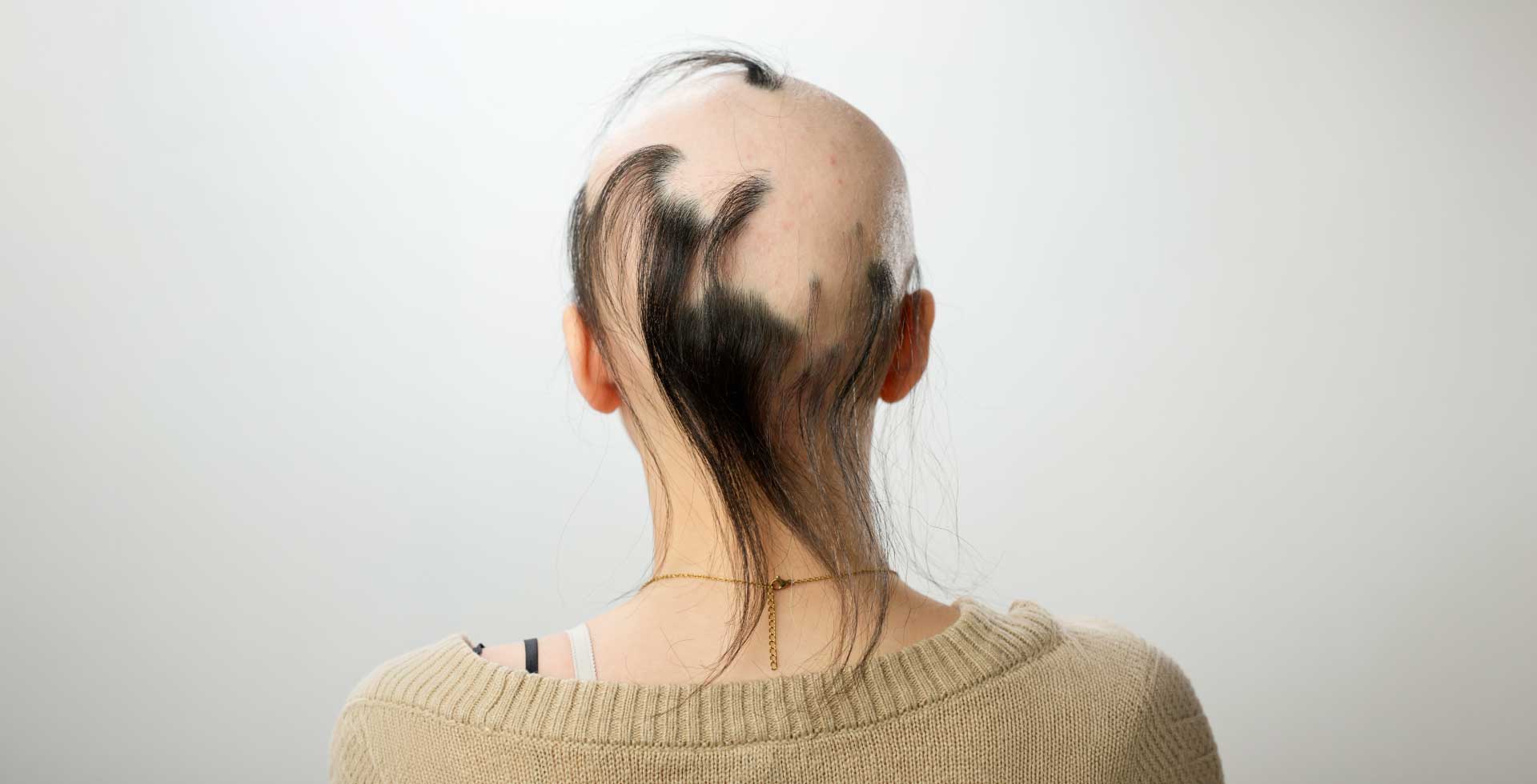 What is alopecia in women example photo