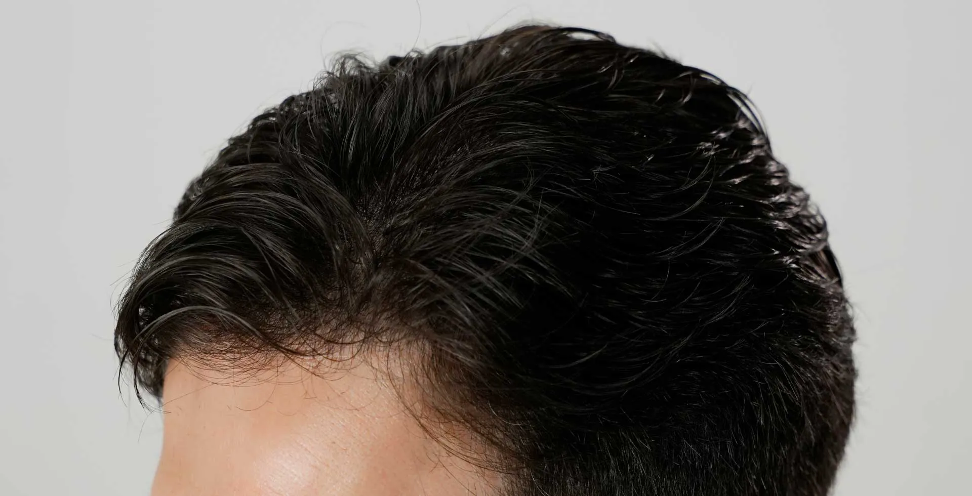 graduated hairline