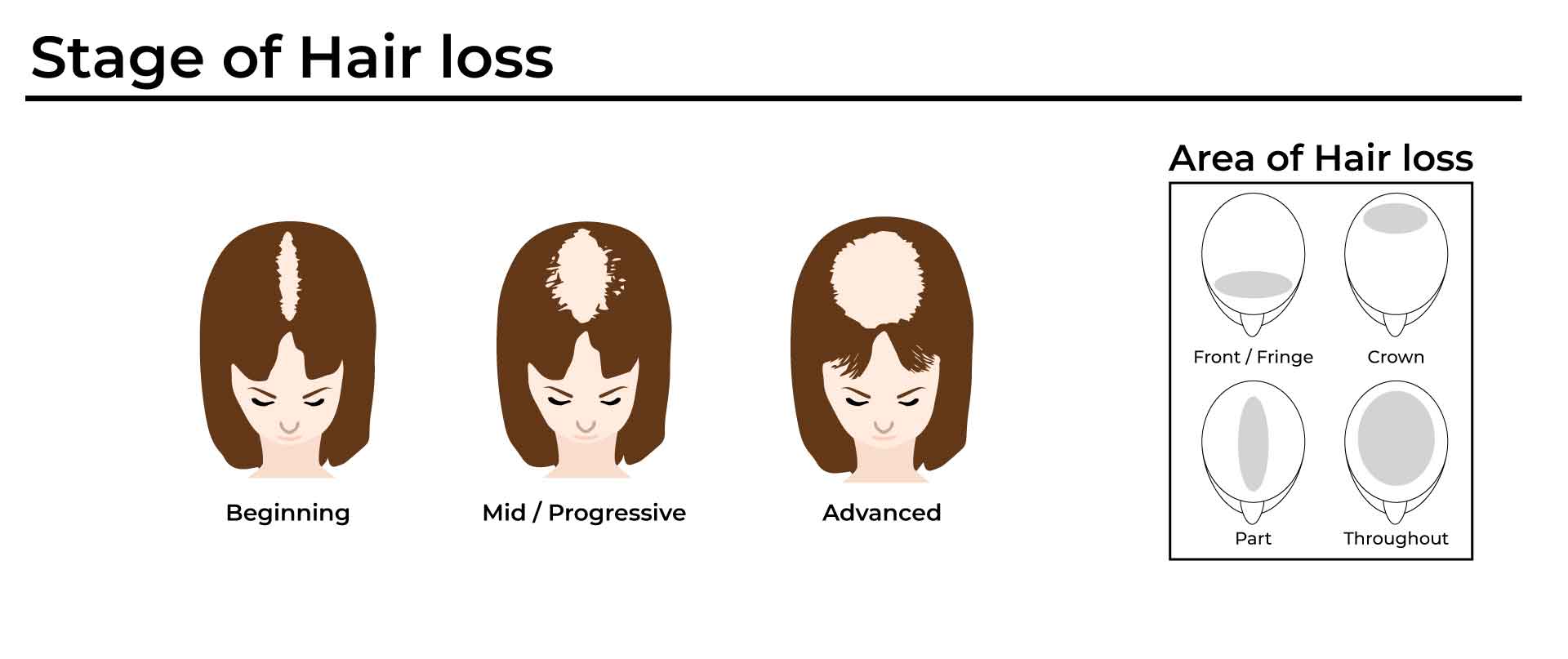 female pattern hair loss