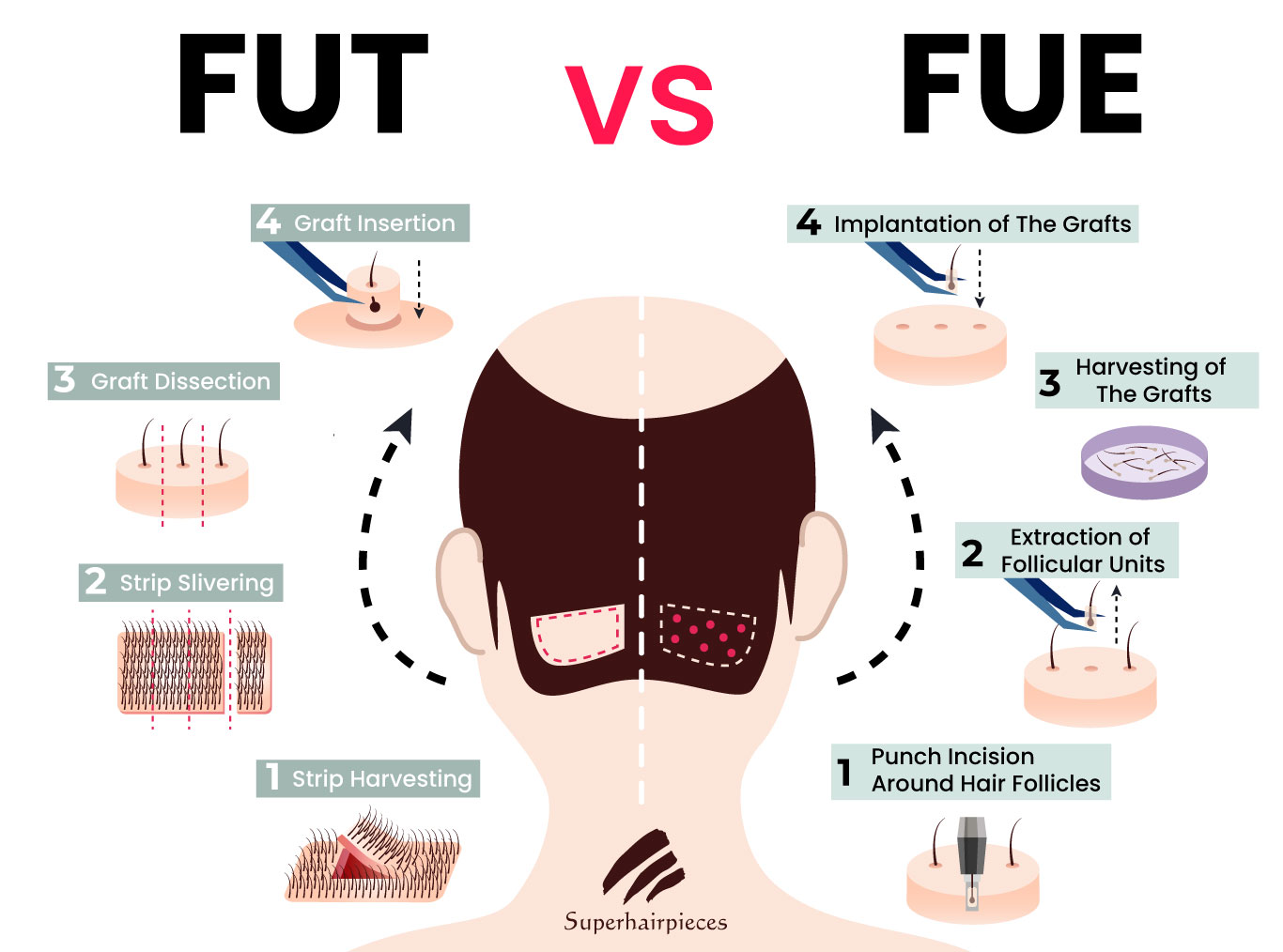 two different hair transplant procedures FUE and FUT