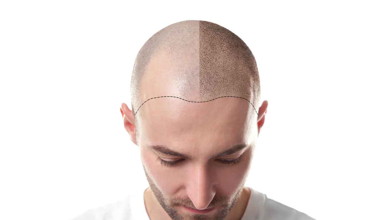 How does a hair transplant work
