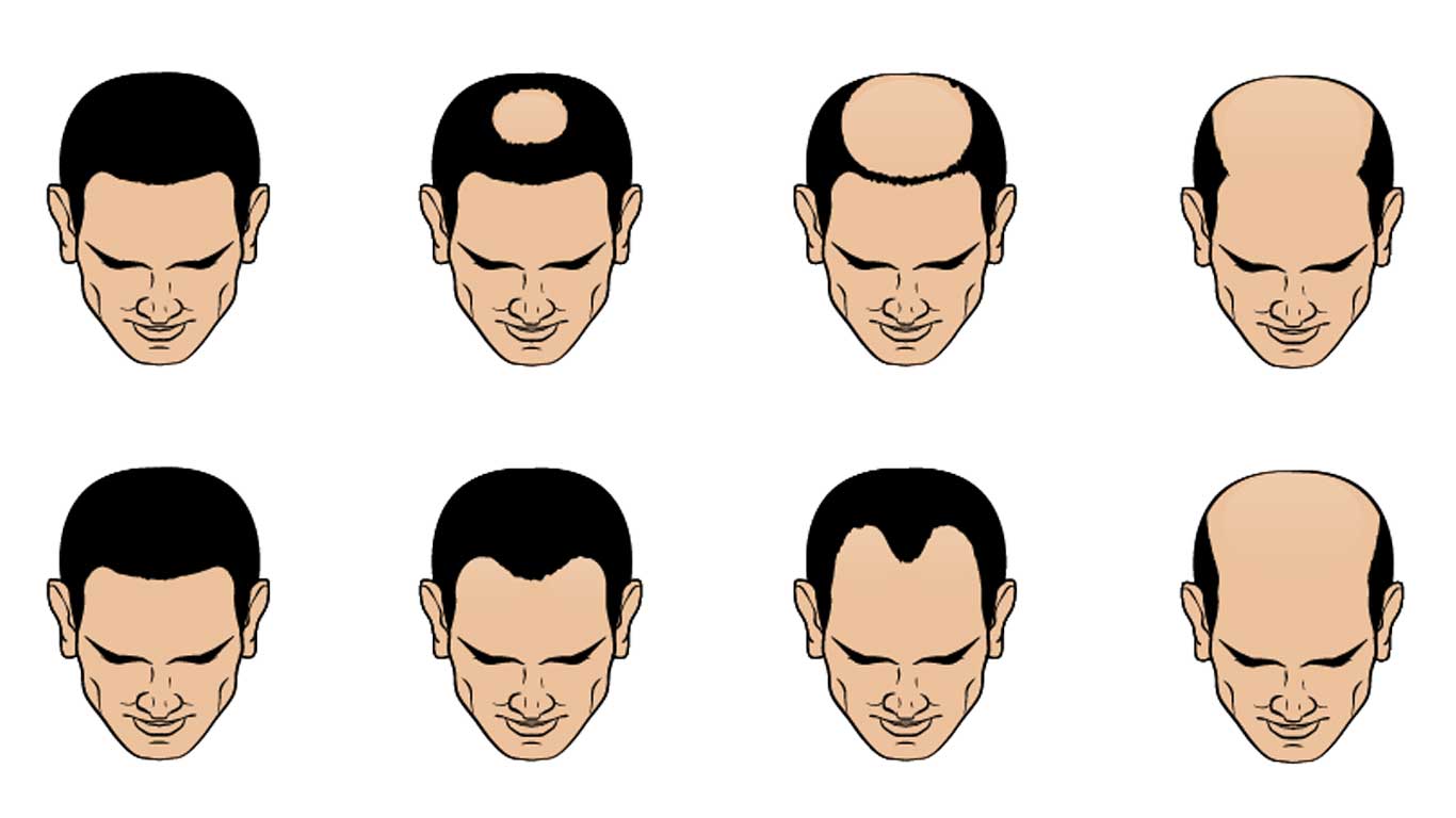 male pattern baldness