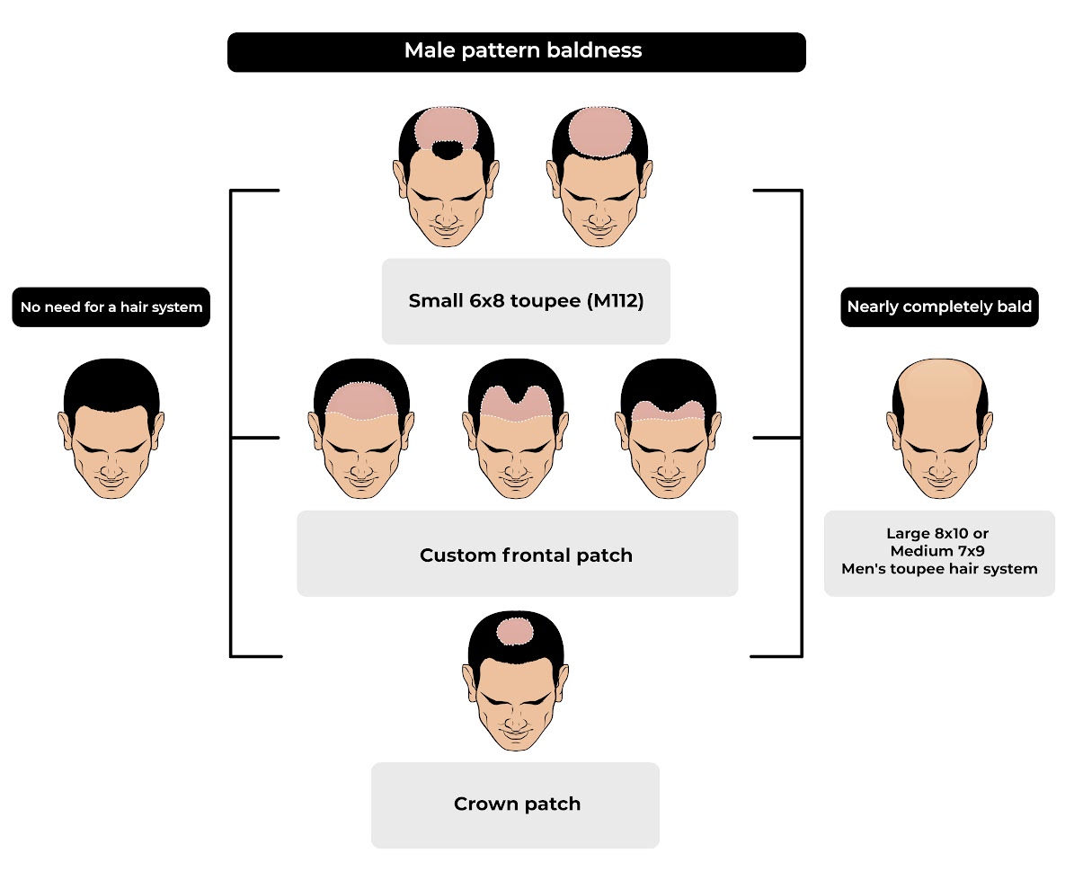 male pattern baldness