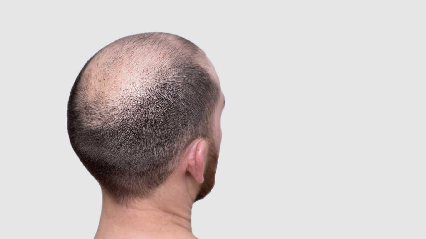 What Causes Hair Loss  Magic Hair